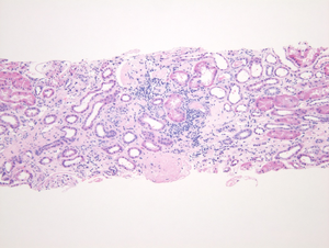 Aldosterone linked to increased risk of chronic kidney disease progression and end-stage kidney disease