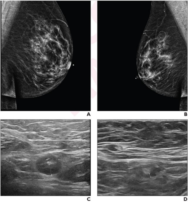 64-year-old woman who underwent screening mammography and breast ultrasound