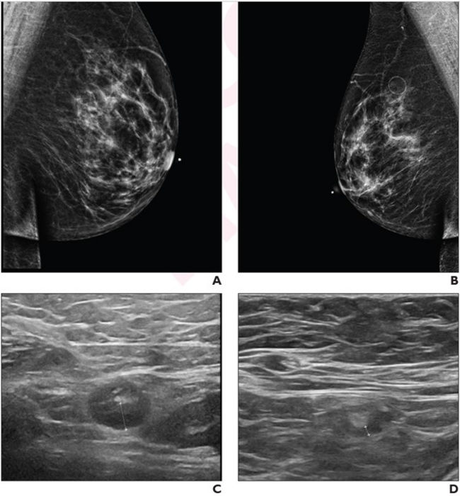 Axillary lymphadenopathy after COVID 19 vacci EurekAlert