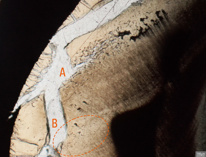 Microscopical section of cremated tooth