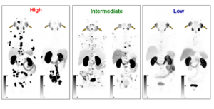 Representative PET images of 6 patients classified as having high, intermediate, and low visual PSG scores.