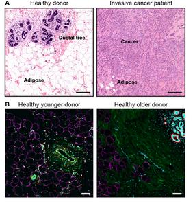 Samples of breast tissue in patients and healthy individuals