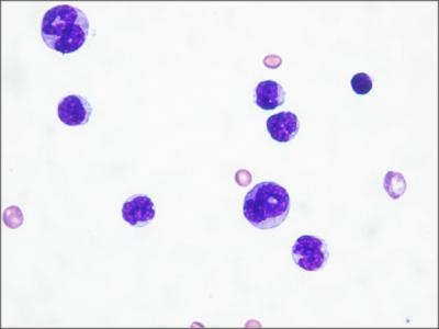 Acute Myeloid Leukemia Cells
