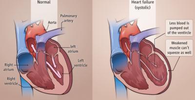 How a Small Molecule Fights Heart Failure (1 of 2)