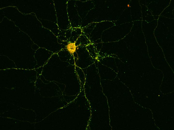 Patient's nerve cell with its extensions: