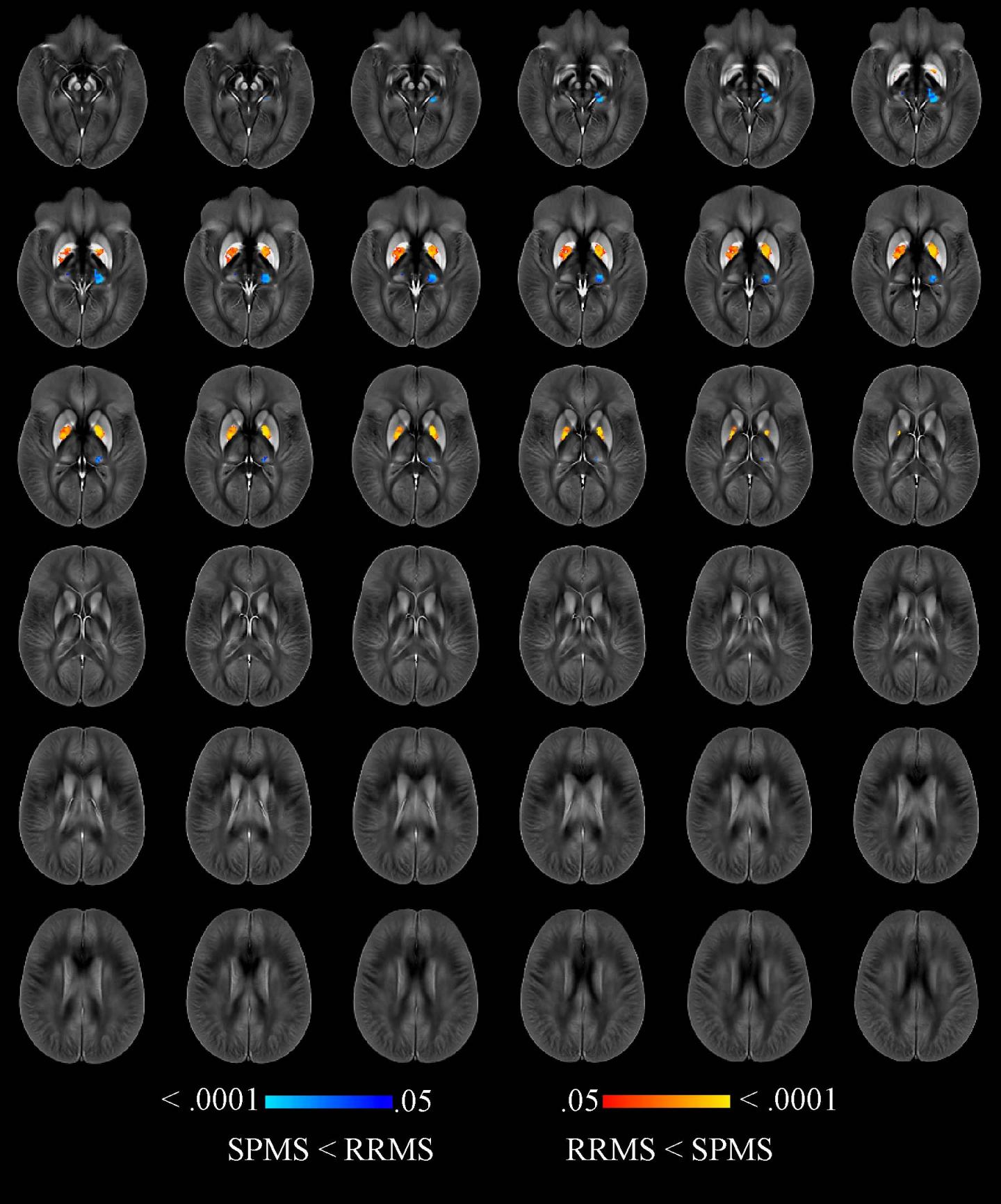 Quantitative Susceptibility Maps w/in Thalamus, Caudate, Globus Pallidus, & Putamen (2 of 3)