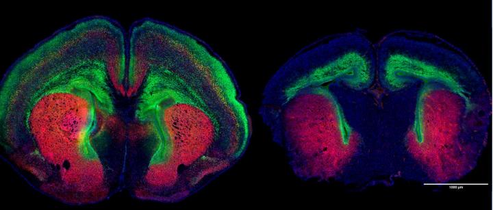 Autism-linked gene causes brain undergrowth