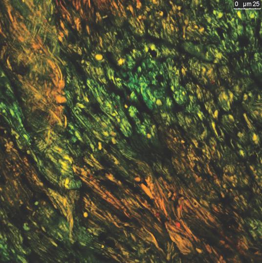 How Cells React to Injury from Open-Heart Surgery