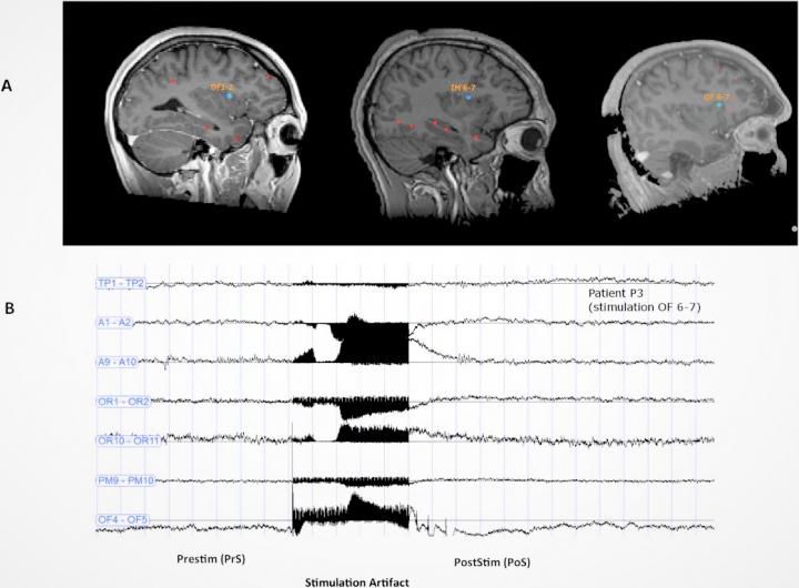 Does Stimulation of the Brain's Dorsal Anterior Insula Trigger Ecstasy?