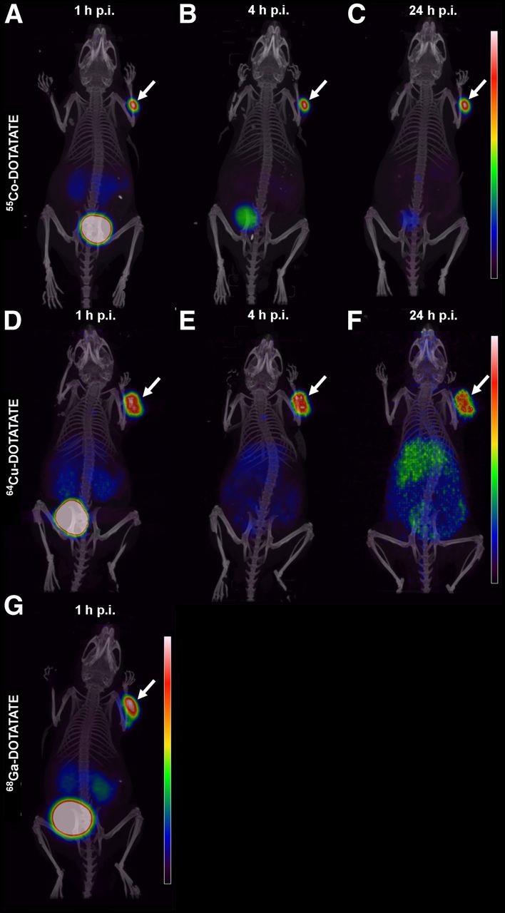 Representative Maximum-Intensity Projection from PET/CT Scan Comparisons
