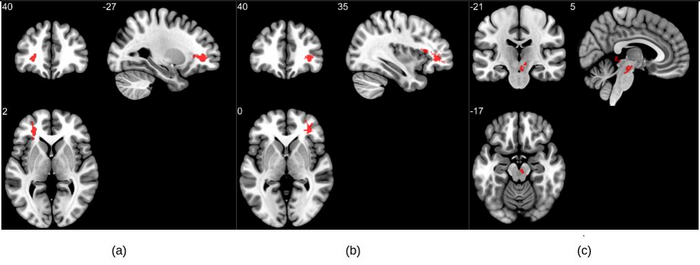 MRI Reveals Significant Brain Abnormalities Post-COVID
