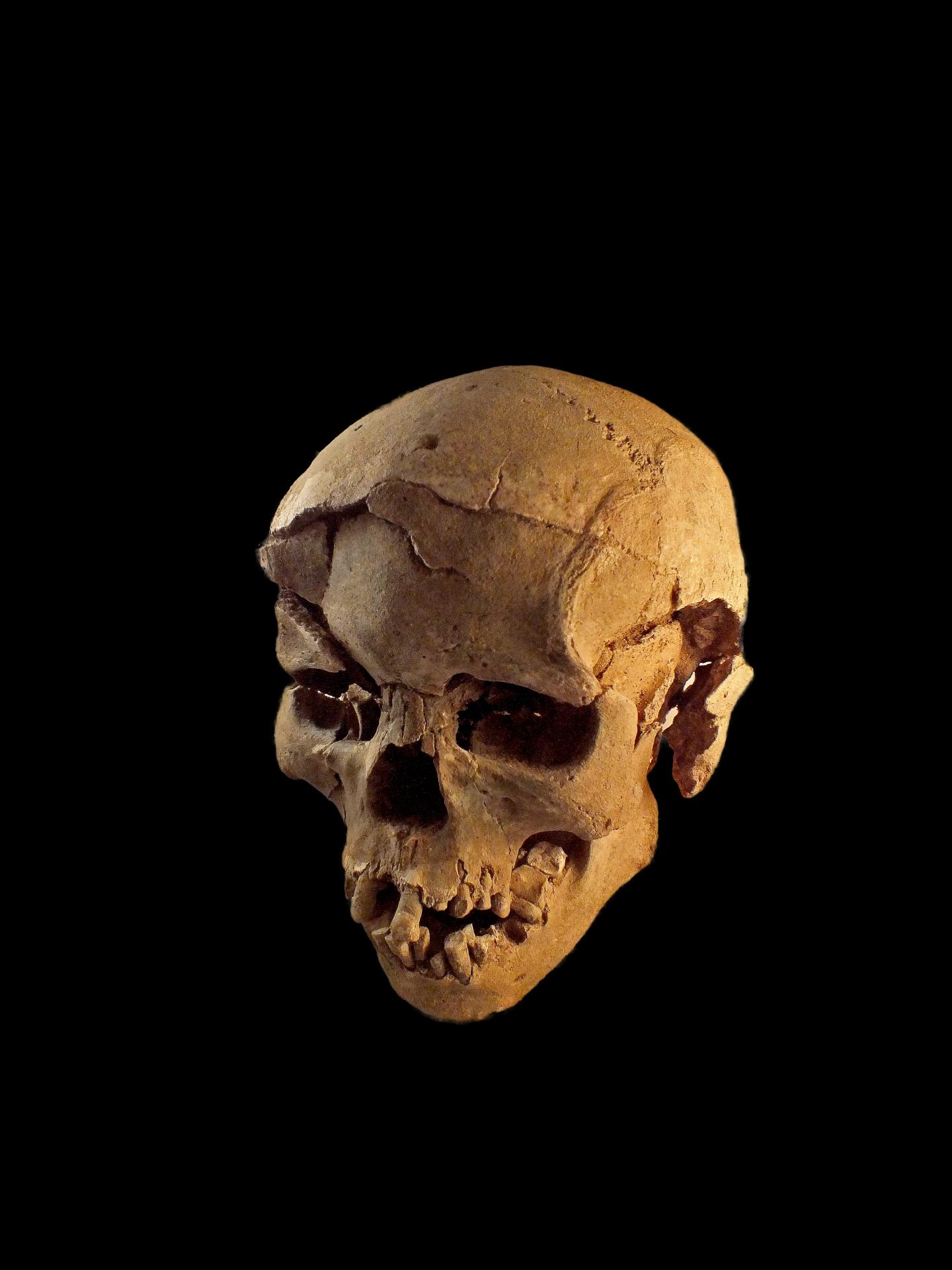 Skull of Adult Male Hunter-Gatherer Who Suffered Severe Blows to the Head