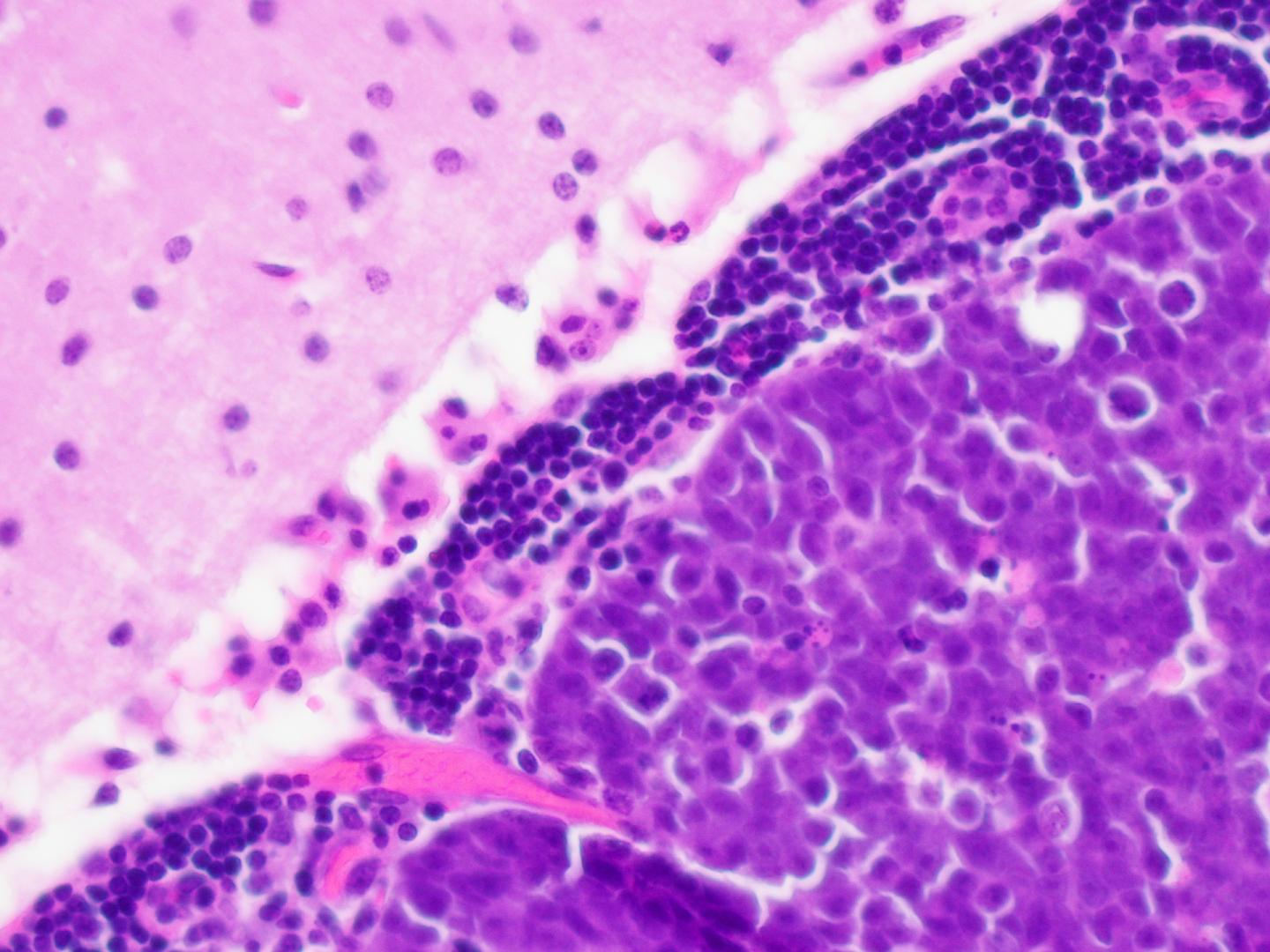 Medulloblastoma