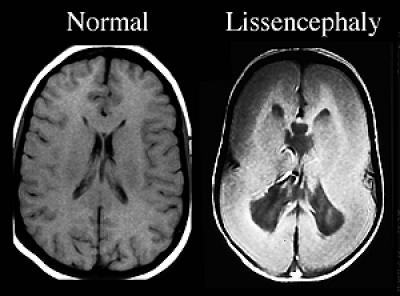 Image of Lissencephalic Brain