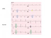 LAFB vs Normal EKG Graphic