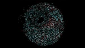 nuclear speckles in renal cancer