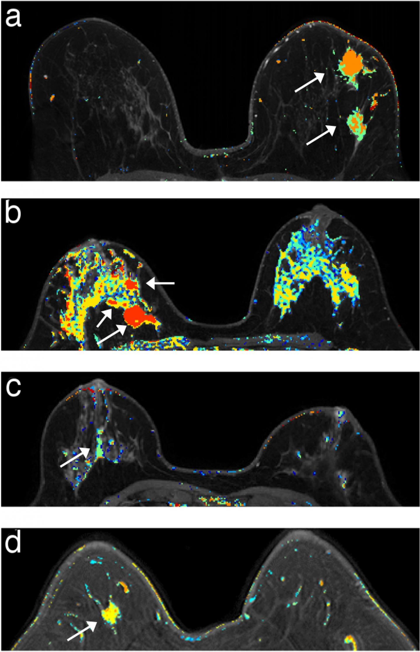 for-women-with-genetic-risk-twice-a-year-mri-eurekalert