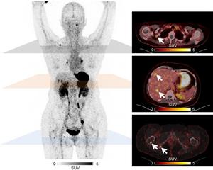 Maximum-intensity projections (left) and fused transaxial sections (right) of 46-y-old female MTC patient undergoing PET/CT