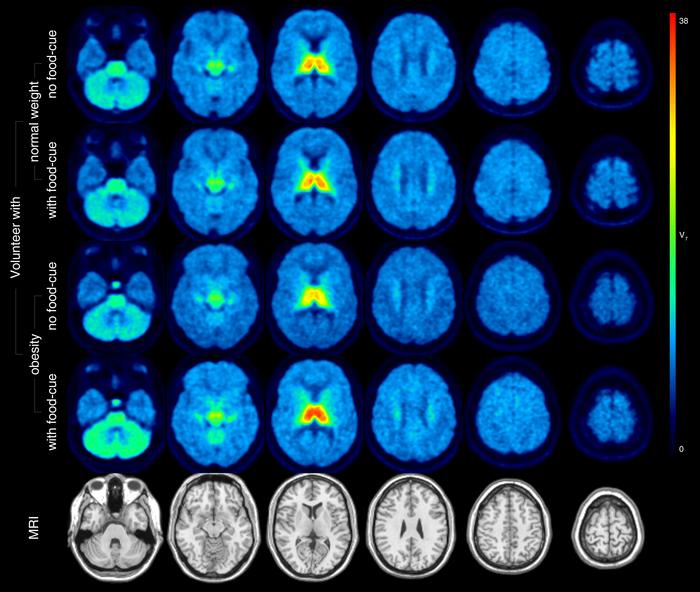 Distribution volumes of α4β2* nicotinic acetylcholine receptors in the brain of normal-weight volunteers and volunteers with obesity.