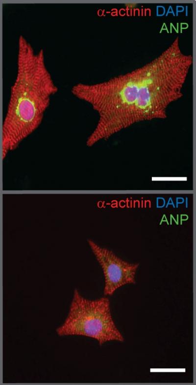 Experimental Treatment Prevents Abnormal Growth of Heart Muscle Cells
