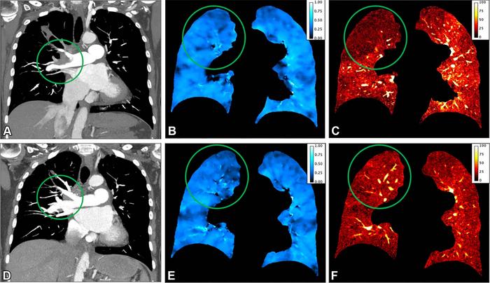 Representative coronal preoperative ventilation-perfusion CT and postoperative ventilation-perfusion CT images obtained after pulmonary endarterectomy.