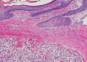 Highly aggressive cell carcinomas