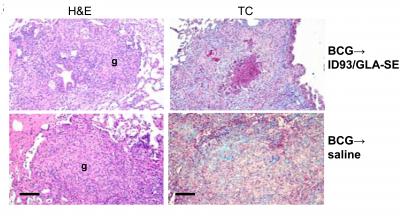 Super Vaccine for Tuberculosis On the Horizon