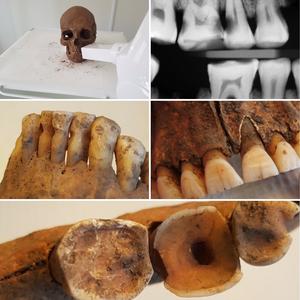 Dental care in Swedish Vikings