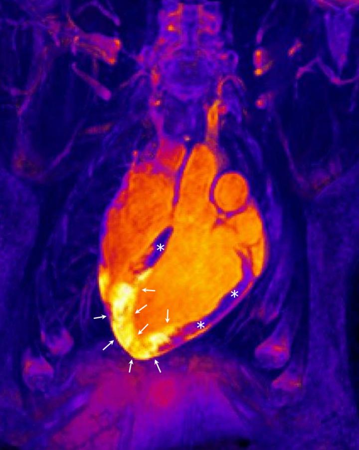 MRI Image of Acute Myocardial Infarction