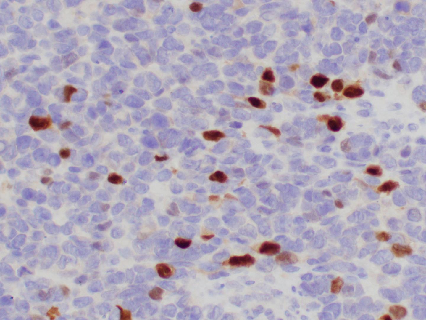 Embryonal Rhabdomyosarcoma Cel [IMAGE] | EurekAlert! Science News Releases