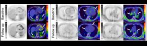 Images of 18F-FAPI PET/CT at baseline and follow-up.