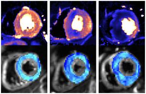 MRI images of the heart