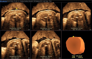 3D ultrasound technique