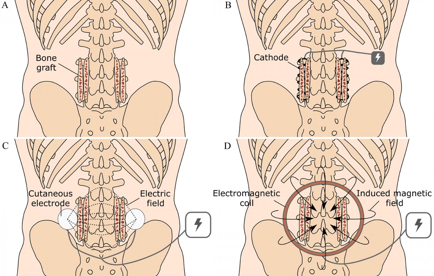 Use of Electrical Stimulation in Producing Spinal Fusion