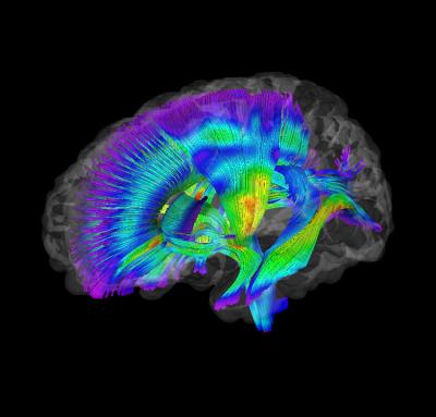 White Matter Pathways in Infants at Risk for Autism