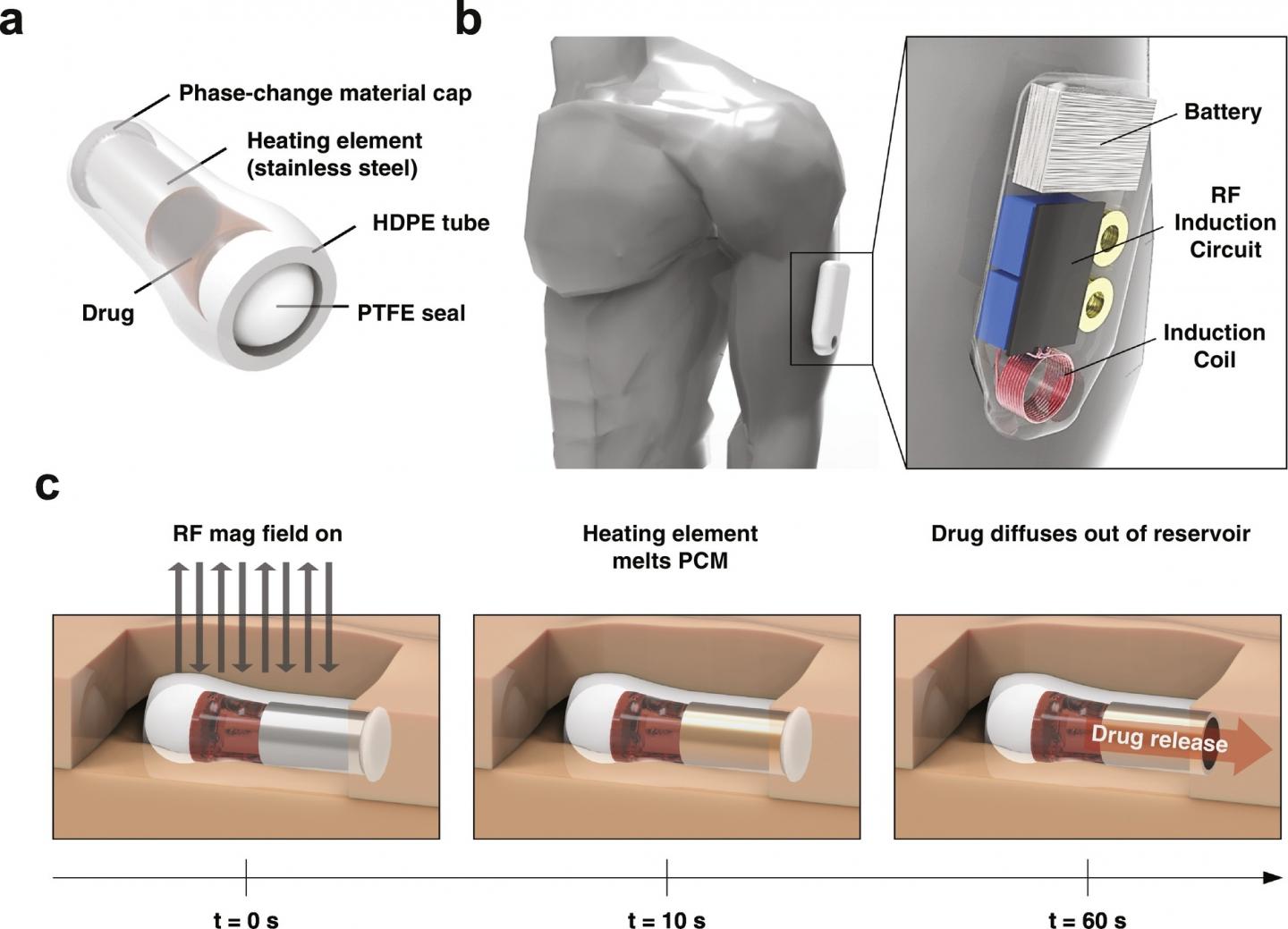 Wearable Opioid Overdose Detection and Antidote Delivery