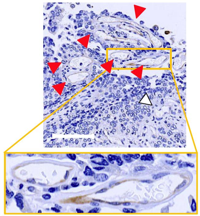 ABCB1-Positive Blood Vessels After Chemotherapy