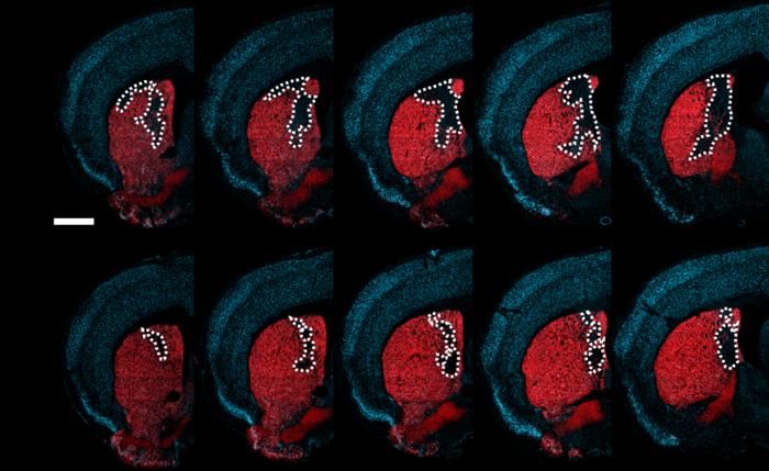 NeuroD1 reduces the areas of the brain with neuron loss