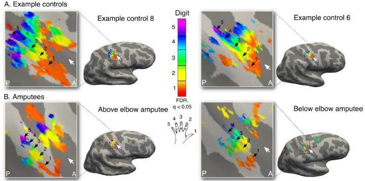 Missing Hand Maps Revealed in Amputees during Phantom Digits Movement