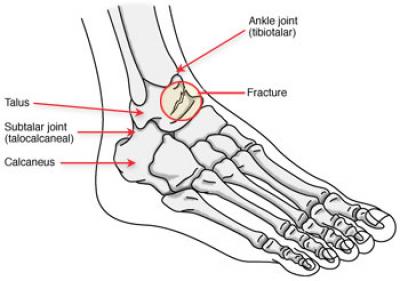 Injuries to the Talus