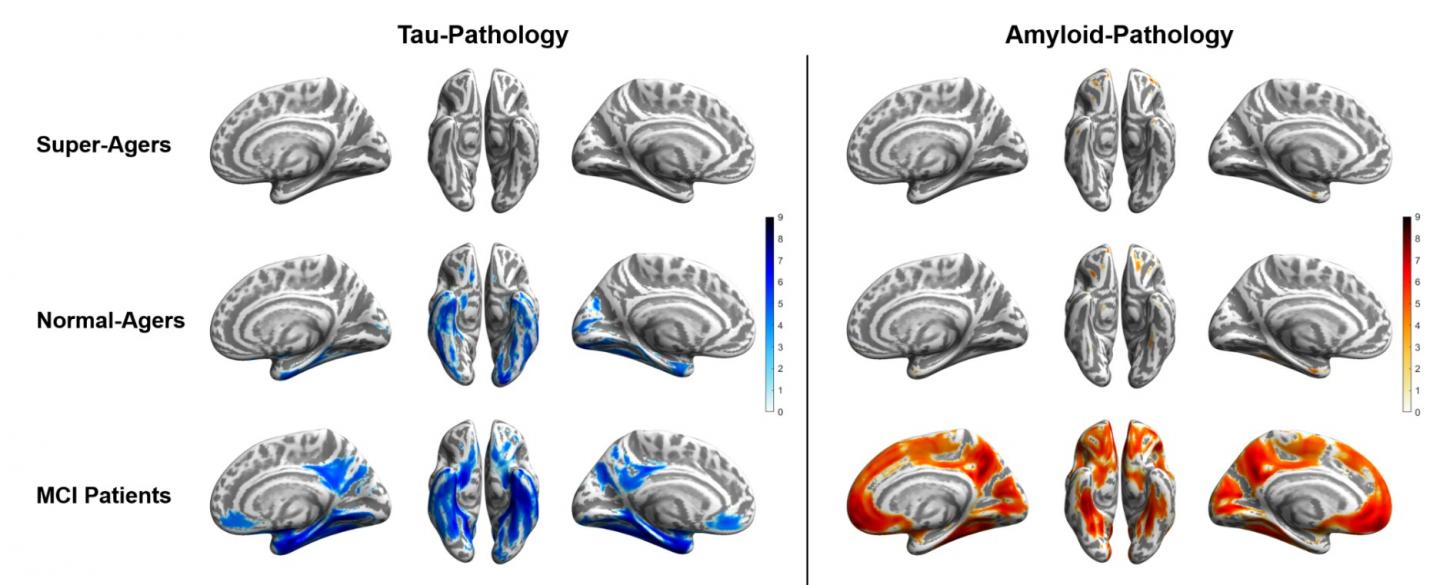 Tau and Amyloid Distribution Patterns