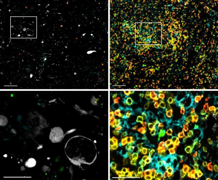 Two-Pronged Gene Therapy For Glioblastoma Pro | EurekAlert!