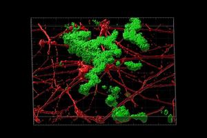 Amyloid beta plaque deposition