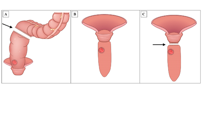 1. Main surgical procedures of specimen extraction in eversion-resection technique of transanal NOSES.