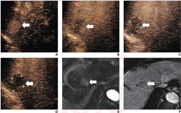 71-year-old woman at high-risk for HCC due to chronic hepatitis B. Patient underwent CEUS using perfluorobutane.