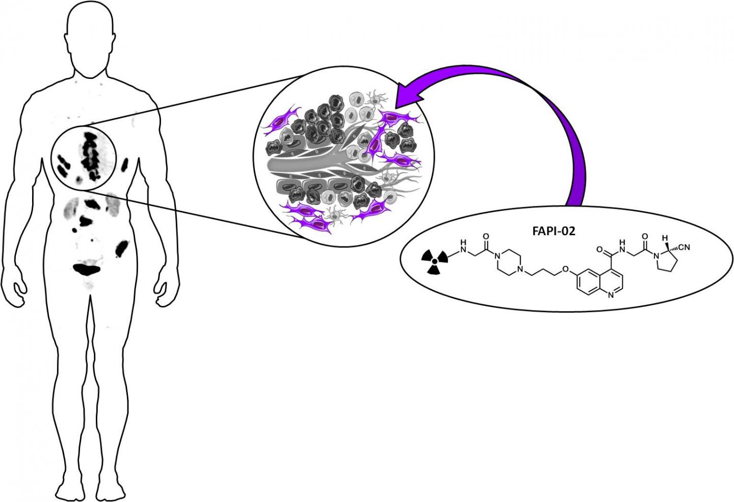 New nuclear medicine imaging method shows str EurekAlert!