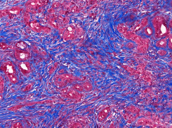 Pancreatic Tumor Environment