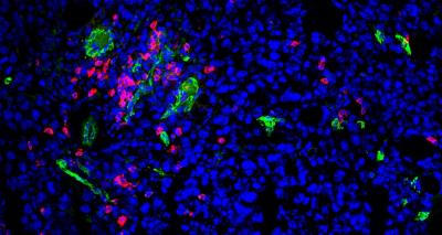CD8 T Cells Infiltrate a Melanoma