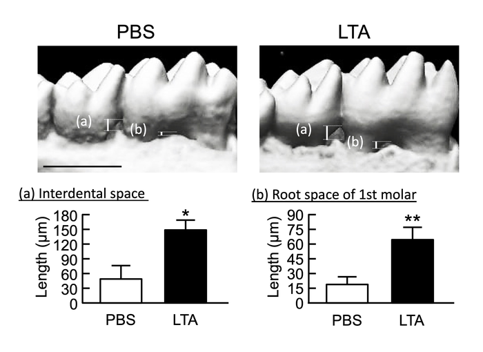 LTA induces alveolar bone loss in mice