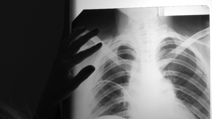 X-Ray from a TB patient